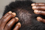 Dark hands on a scalp showing dandruff and dry hair