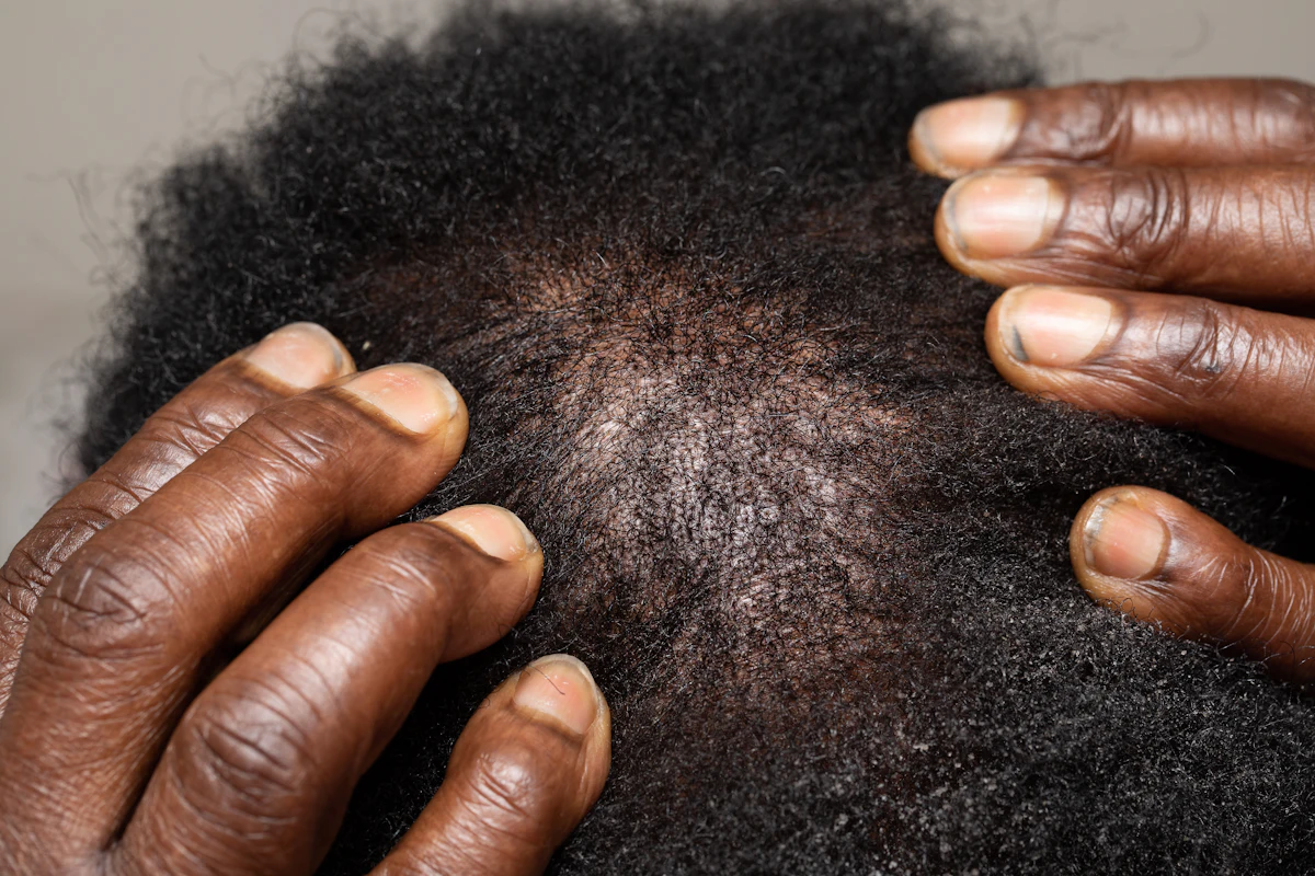 Mesotherapy (Hair)