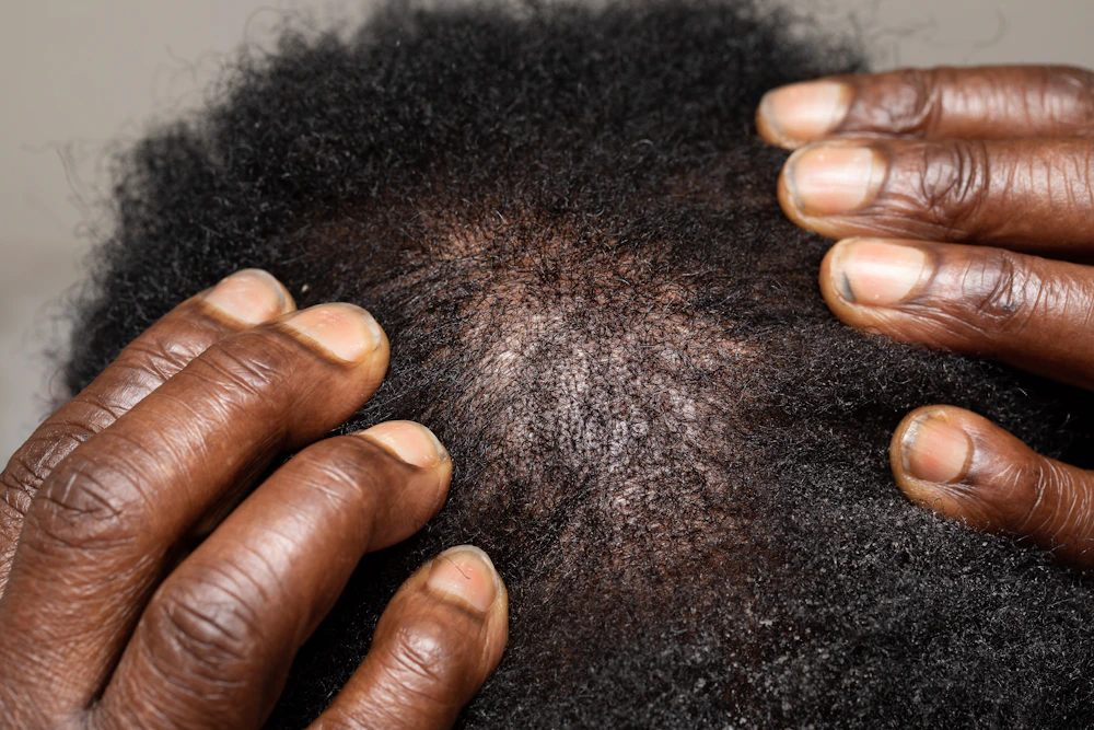 Hands examining a scalp for hair loss and scalp concerns