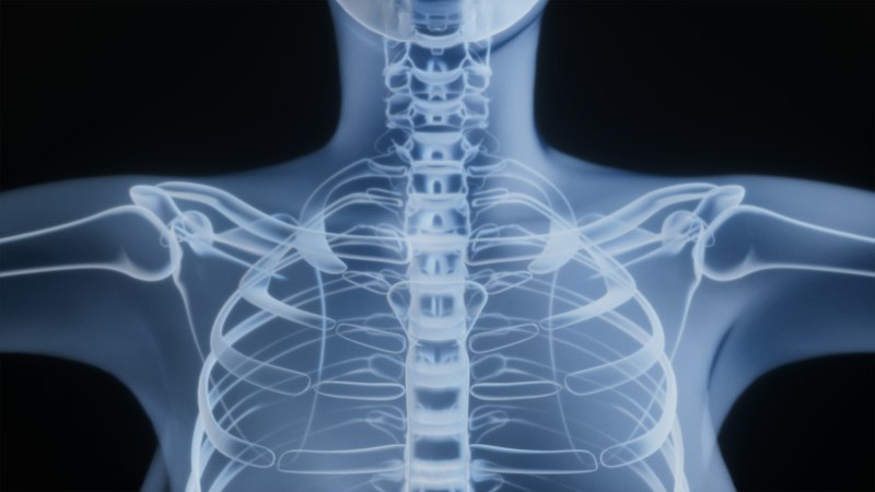 Gerinc MR lelet szótár: porckorongsérv, spondylosis, foramen szűkület – mit jelent a leleted?