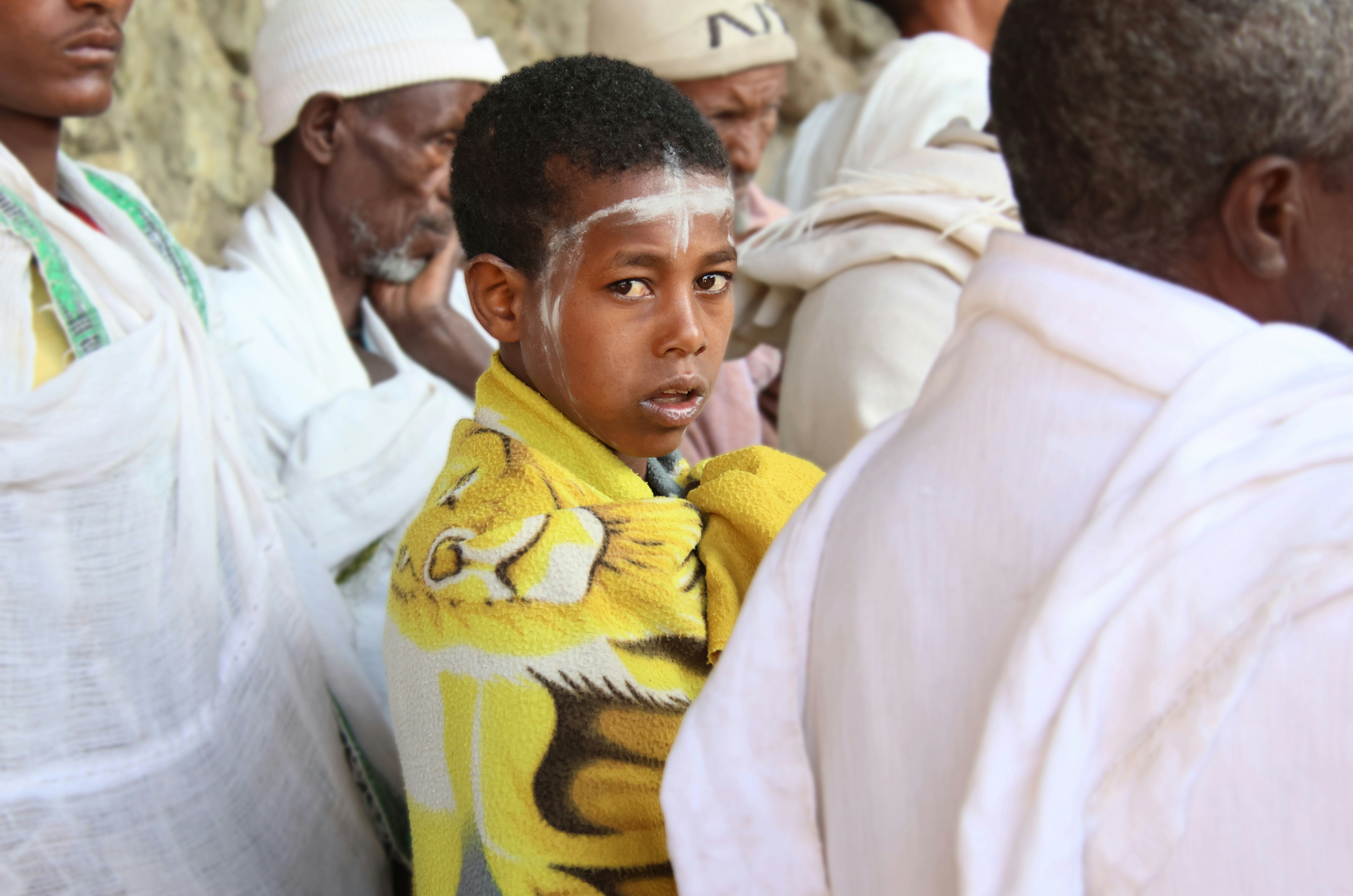 Young boy with white markings and yellow blanket.