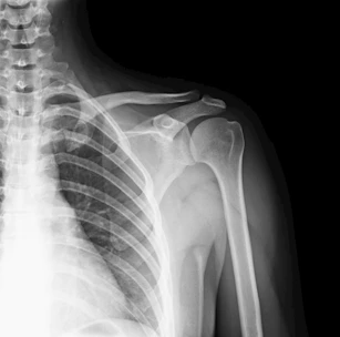 X-ray of a human shoulder and upper arm