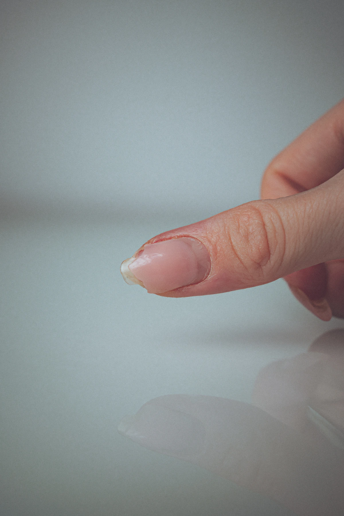 Close-up of a hand with a damaged fingernail, representing nail discoloration and damage care