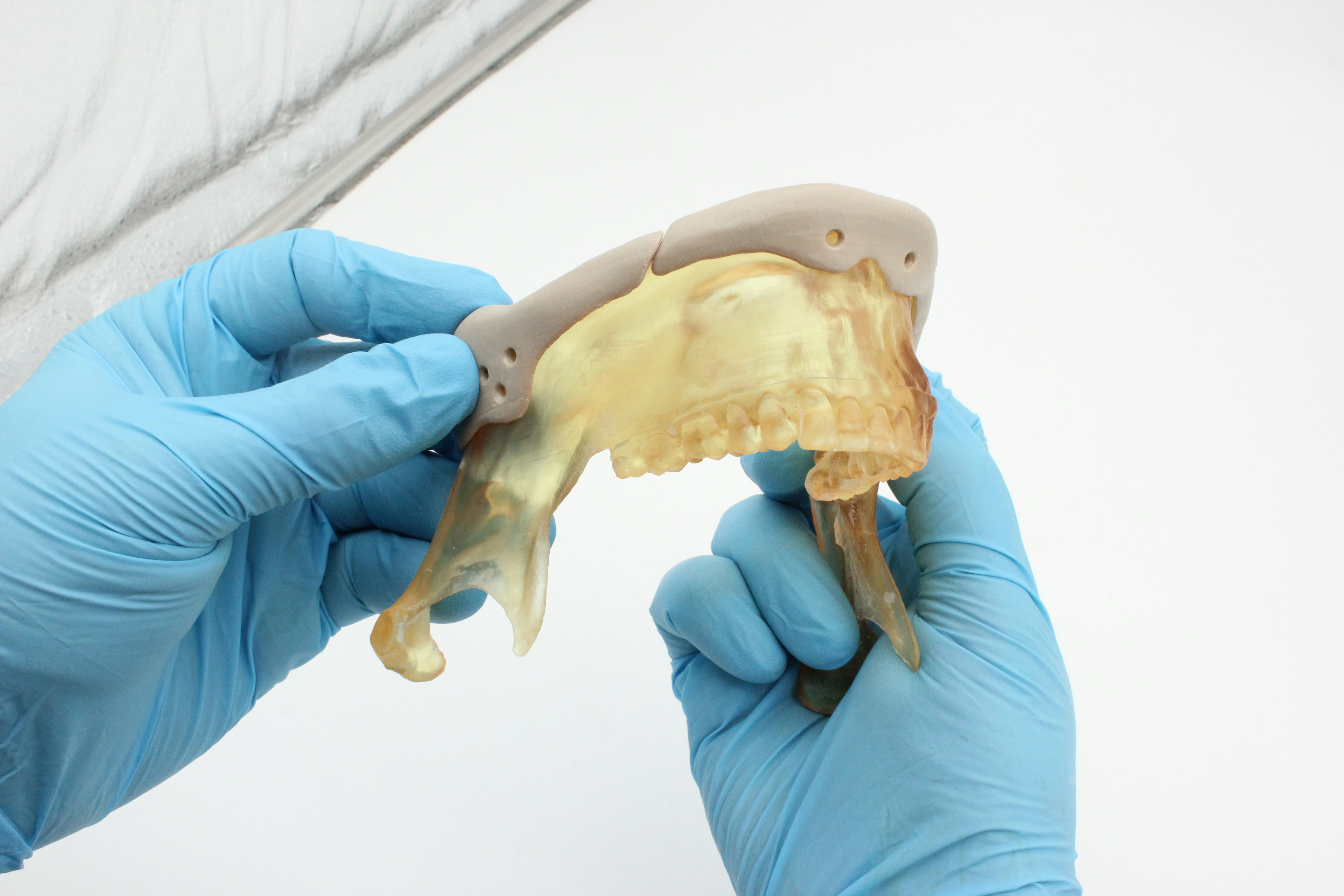 Hands in blue gloves holding a dental model.