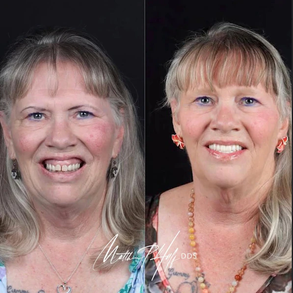 Woman before and after dental cosmetic improvements