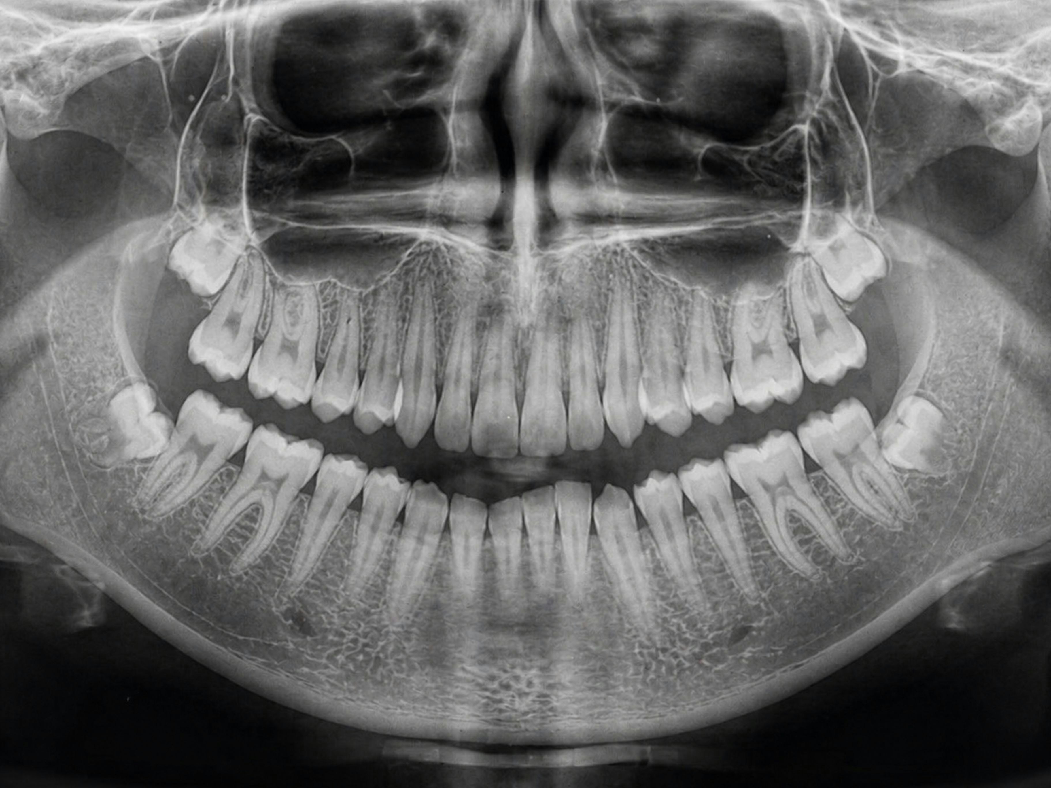 Close-up of a 3D CBCT scan used for planning All-on-4 dental implant placement