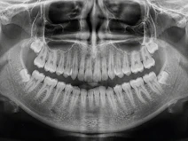 Panoramic dental x-ray showing teeth and jawbone