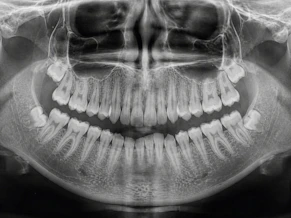 Panoramic dental x-ray showing teeth and jawbone