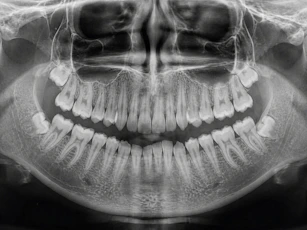 Panoramic dental x-ray showing teeth and jawbone