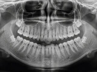Panoramic dental x-ray showing teeth and jawbone