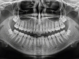Panoramic dental x-ray showing teeth and jawbone
