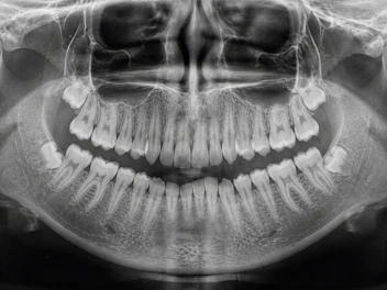 Panoramic dental x-ray showing teeth and jawbone