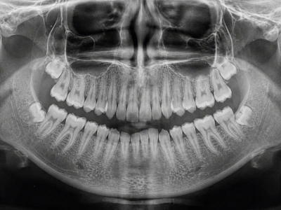 Panoramic dental x-ray showing teeth and jawbone