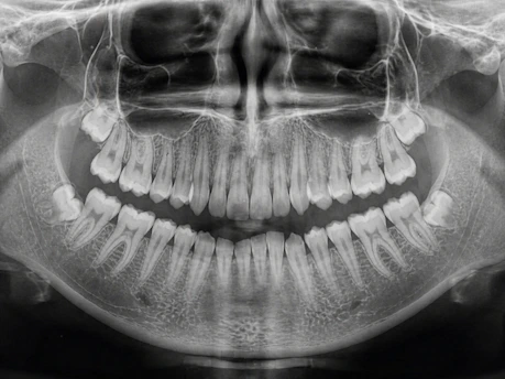 Panoramic dental x-ray showing teeth and jawbone