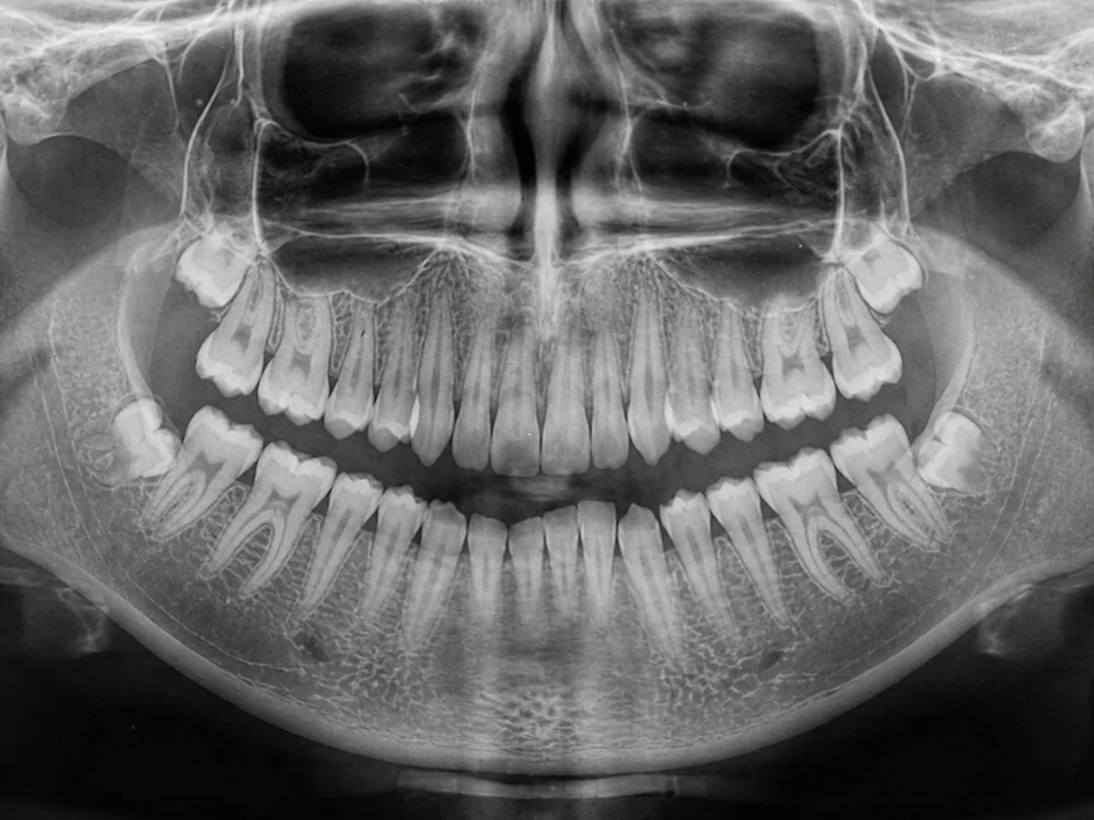 Panoramic dental x-ray showing all the teeth, including the wisdom teeth at the back