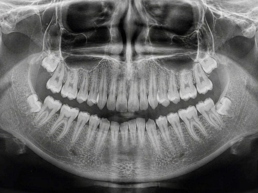 Panoramic dental X-ray showing the teeth and jawbone