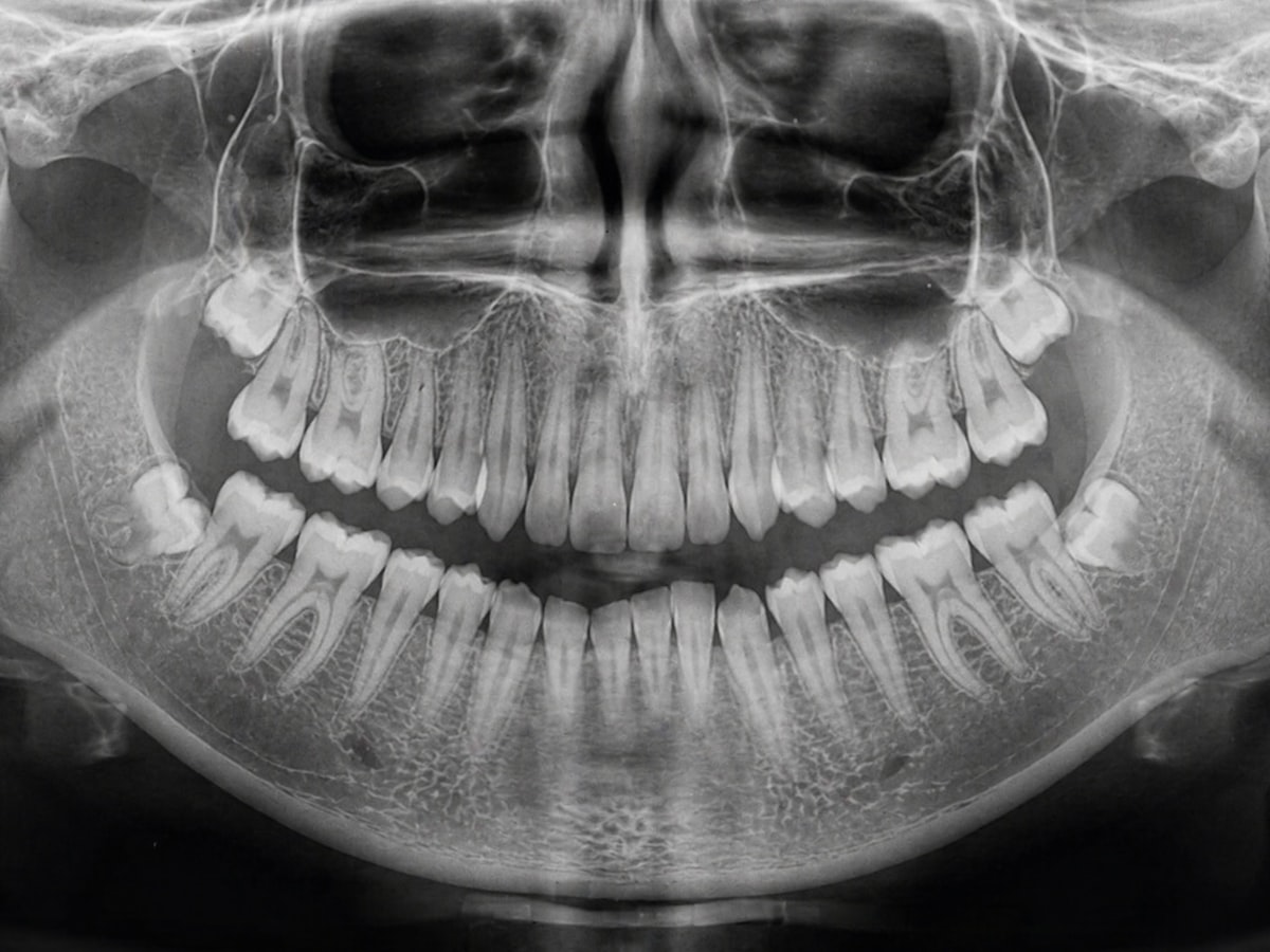 Radiografía panorámica dental que muestra raíces y estructura ósea
