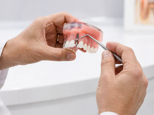 Dentist demonstrating dental implant on model