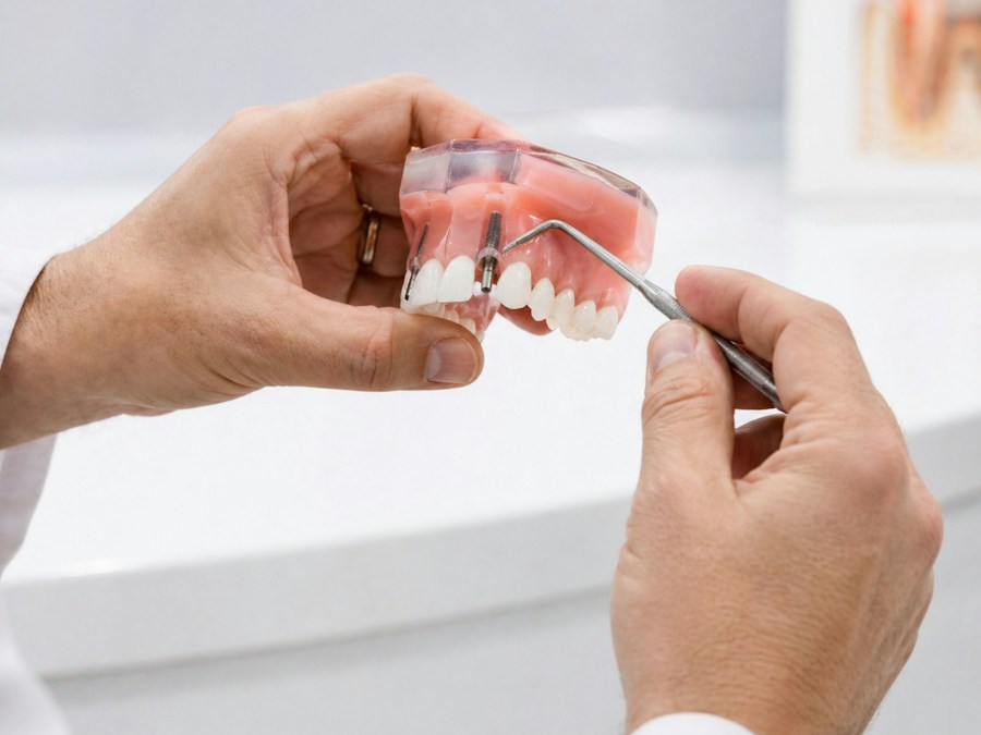 Prótesis fija sobre implantes