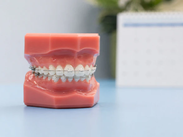 Dental model with metal braces on teeth