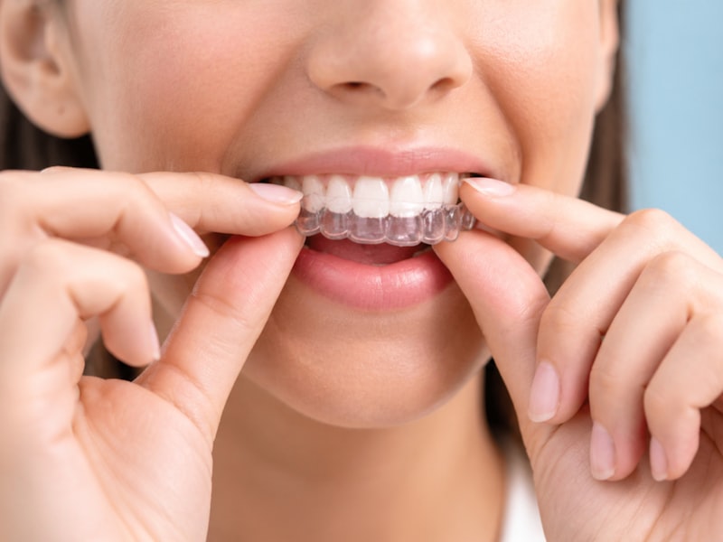 Adult with clear aligner