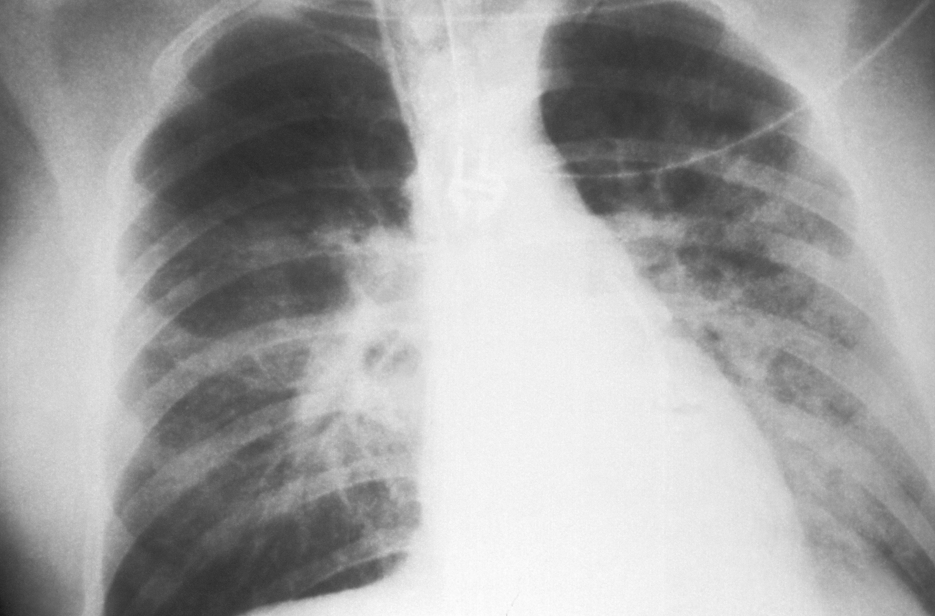 ID#: 6077 Caption: This AP chest x-ray reveals the mid-staged bilateral pulmonary effusion due to hantavirus pulmonary syndrome, or HPS. Radiologically, HPS begins with interstitial pulmonary edema, progressing to alveolar edema with severe bilateral involvement. Pleural effusions are common, and are often large enough to be evident radiographically, as was the case, here. Content Provider(s): CDC/ D. Loren Ketai, M.D. https://wwwn.cdc.gov/phil/Details.aspx?pid=6077