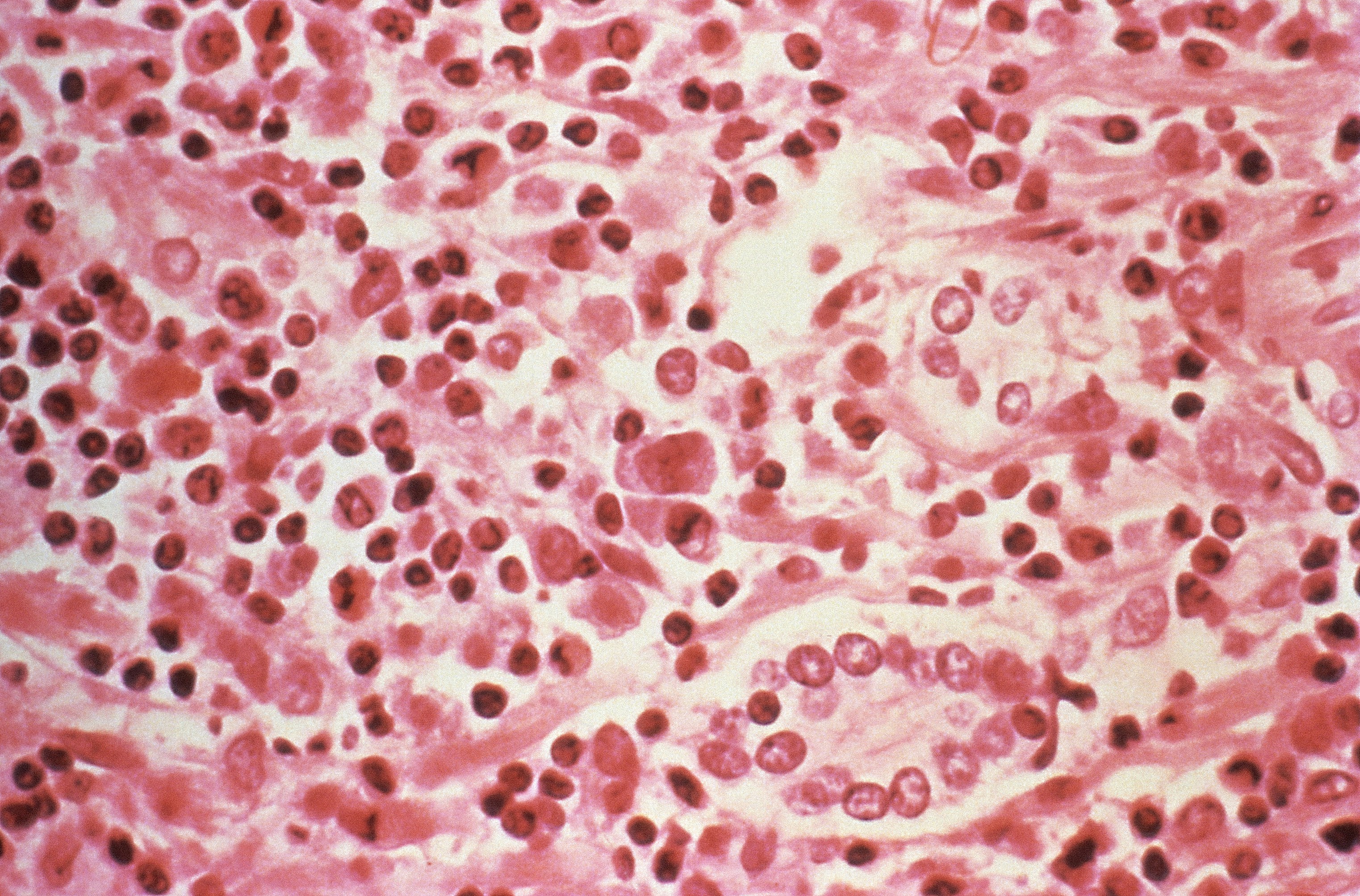 Review of gynecologic malignancies highlights dormant tumor cells as a therapeutic target