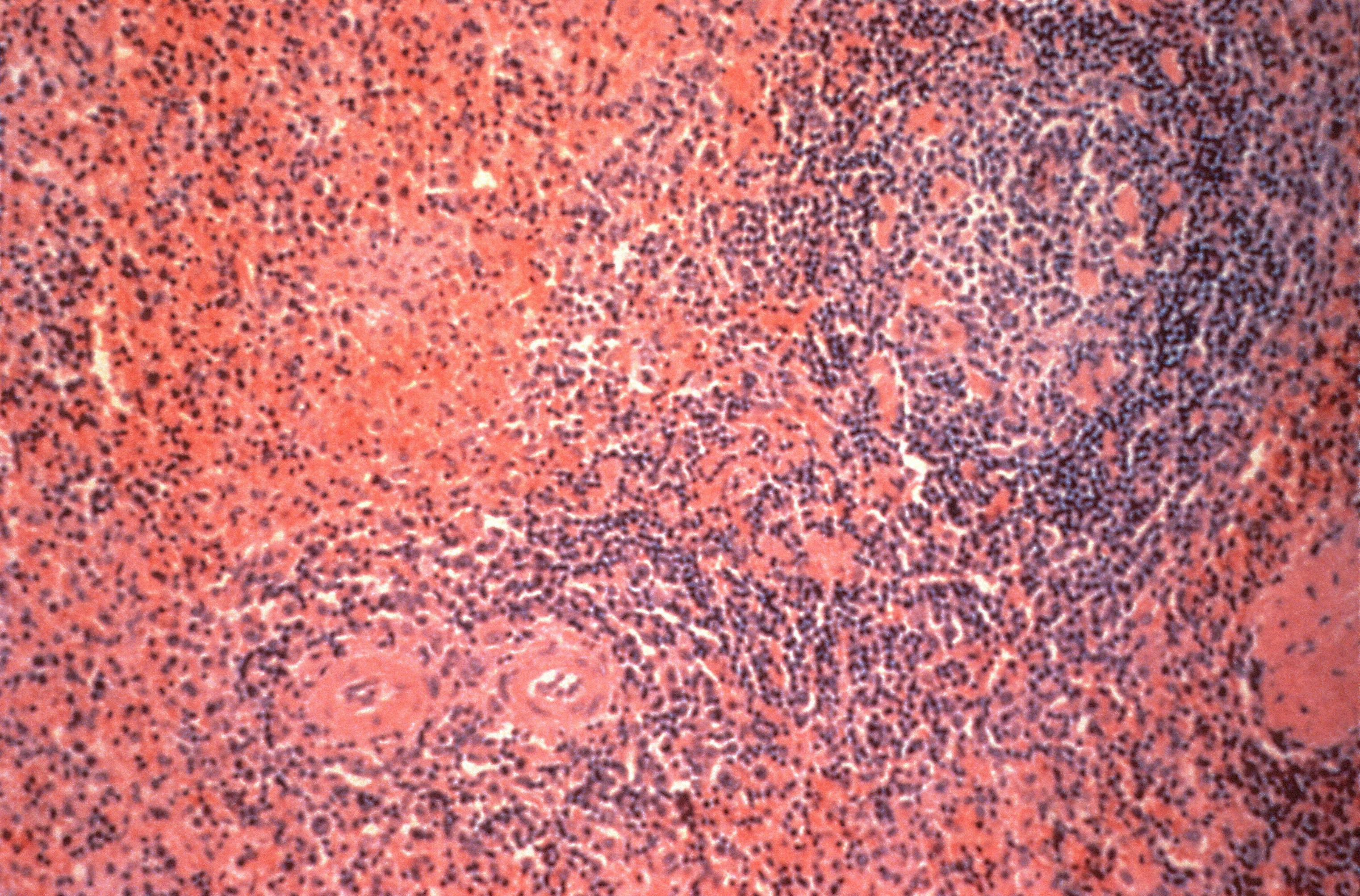 Case report review of clindamycin use in a 62-year-old male with Neurofibromatosis type 1 and hematoma