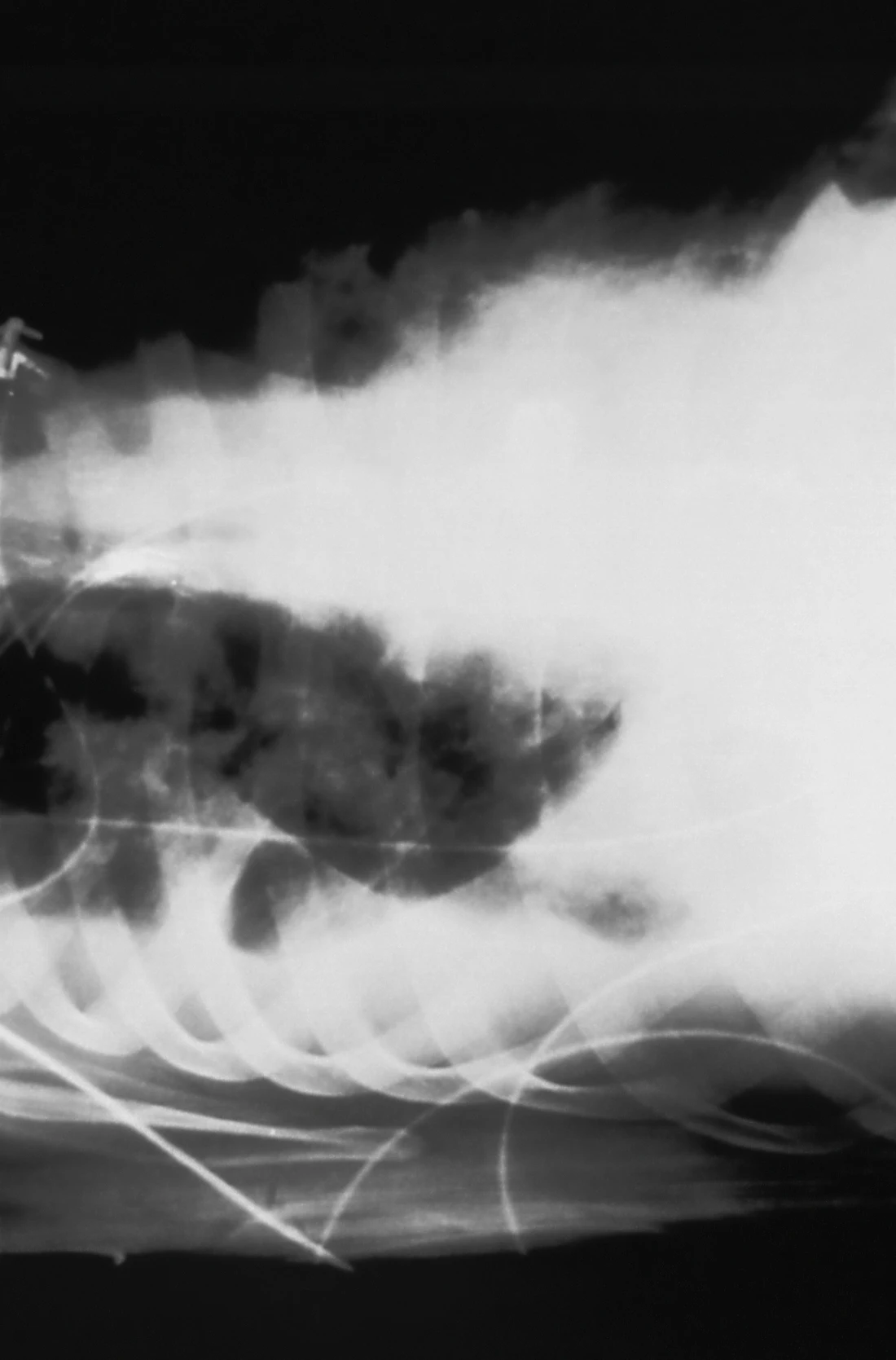 A chest radiograph showing fluid in the lung, illustrating pneumonia as a leading cause of sepsis in nursing homes