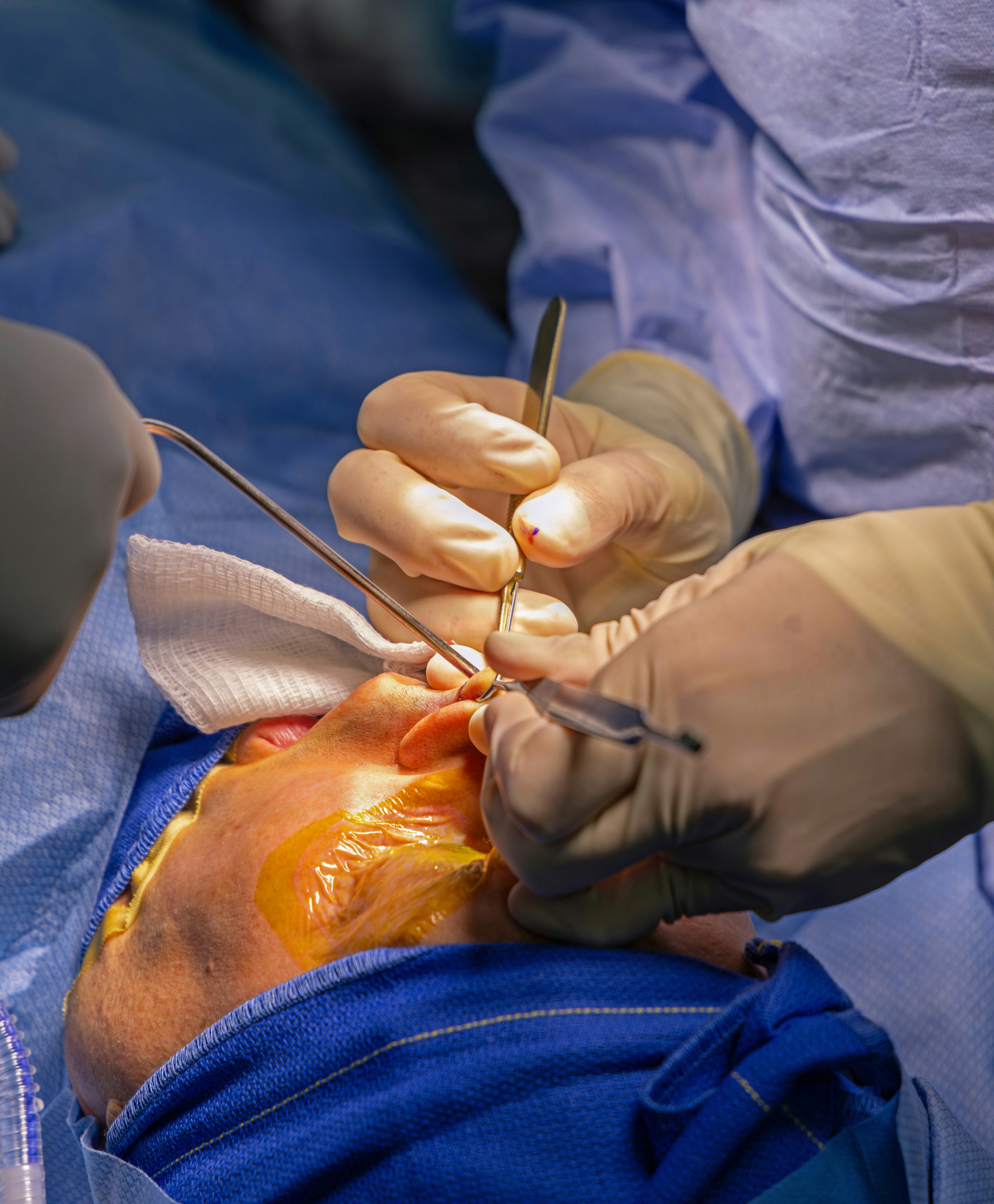Surgeons operate on a patient's face with surgical instruments.