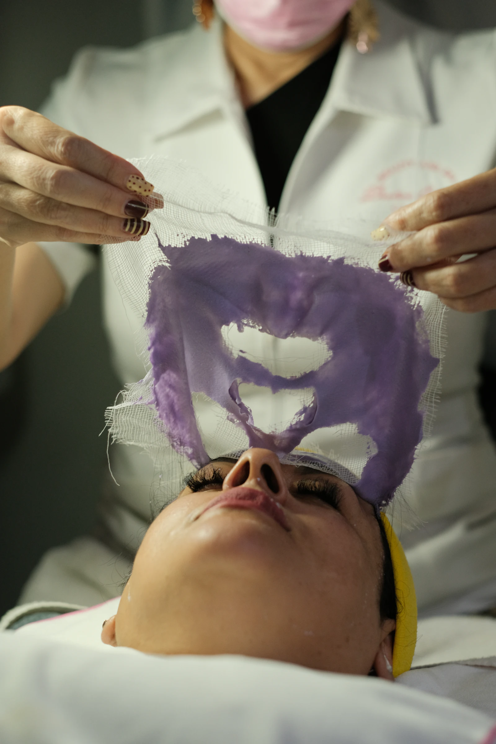 Melasma Injection