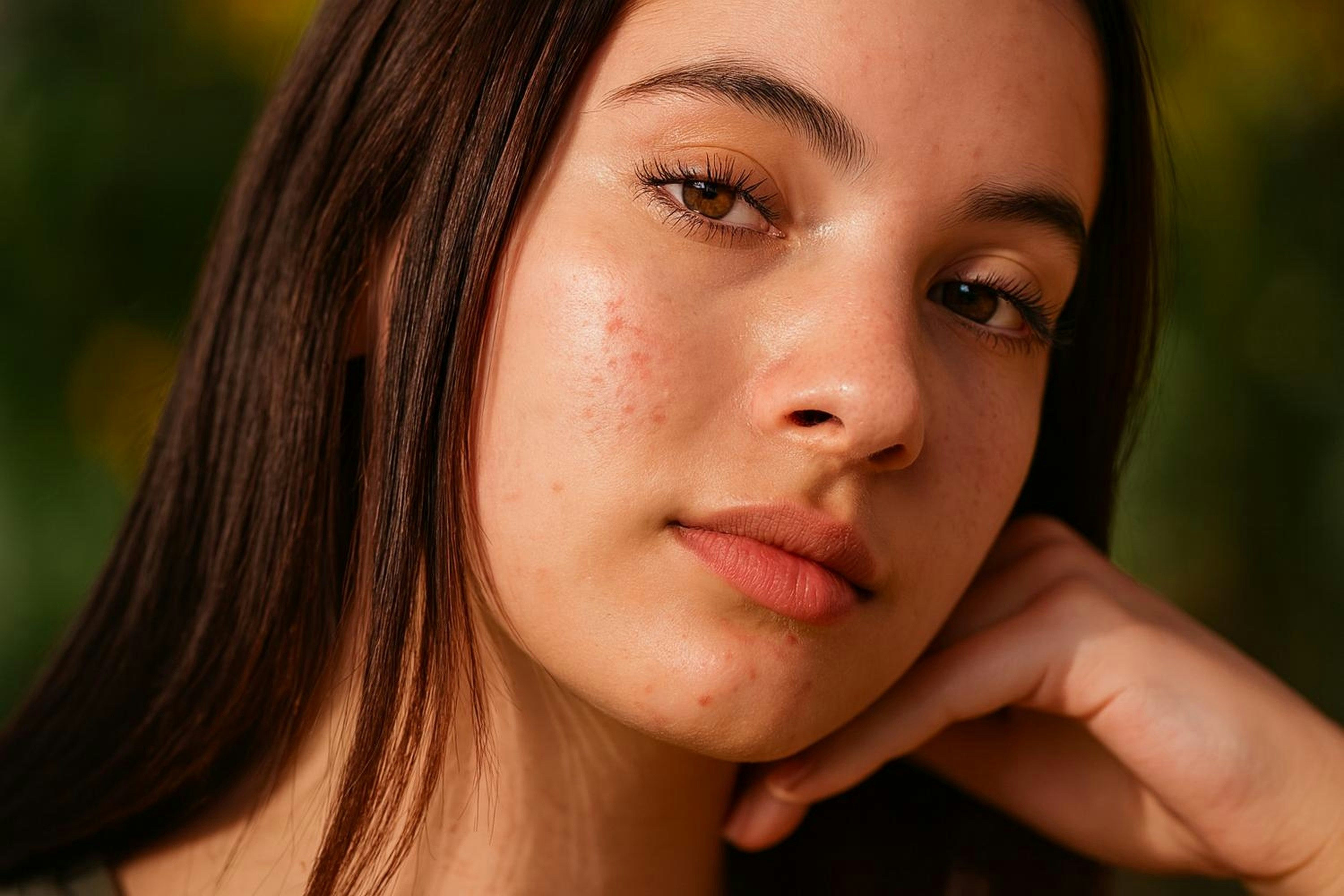 acne treatment close up, wallpaper, Scars Bacterial Acne Jawline: Treatment & Prevention 5