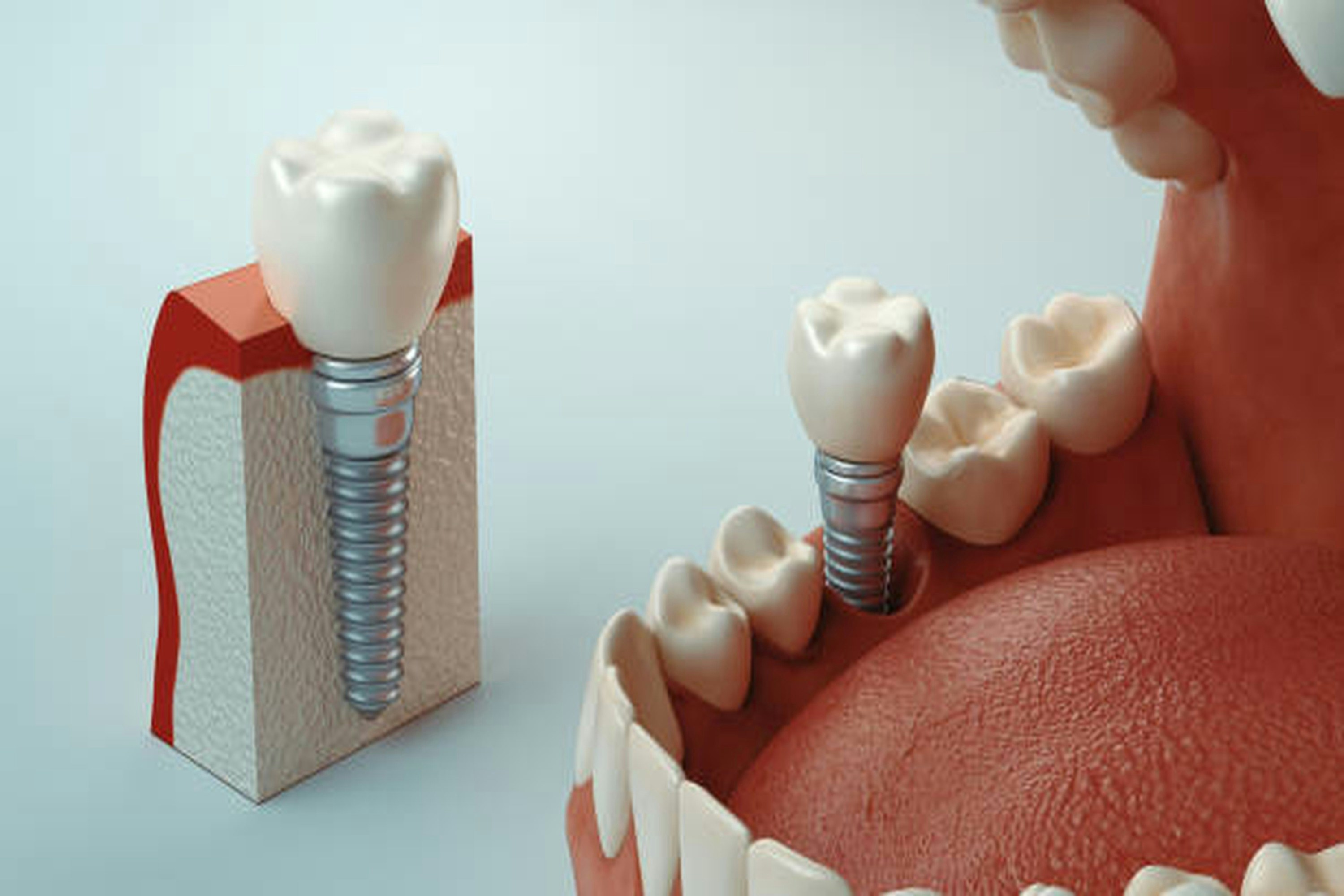 single dental implant anatomy