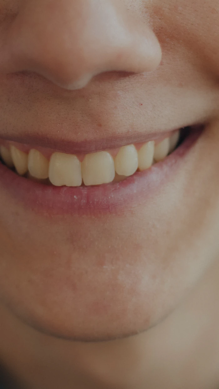 Sonrisa con carillas de porcelana de aspecto natural