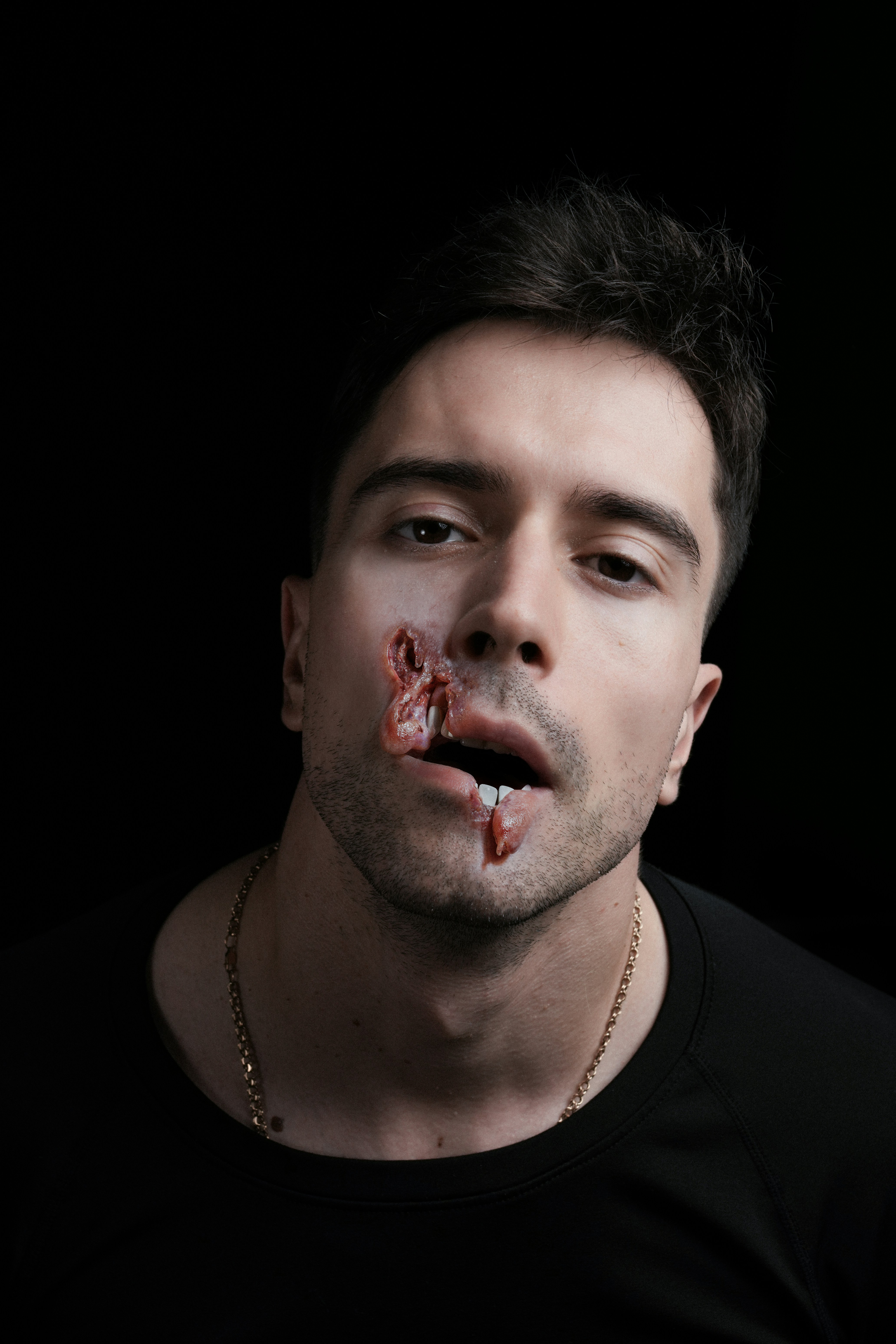 A man with a facial injury and exposed teeth against a black background